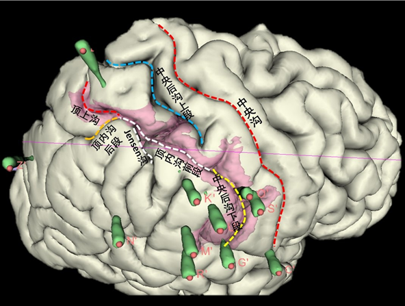 通过SEEG定位后在3D脑上绘制切除计划