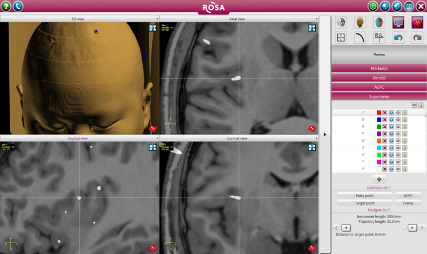 SEEG电极植入后影像融合图，可清晰显示每个电极触点的具体位置