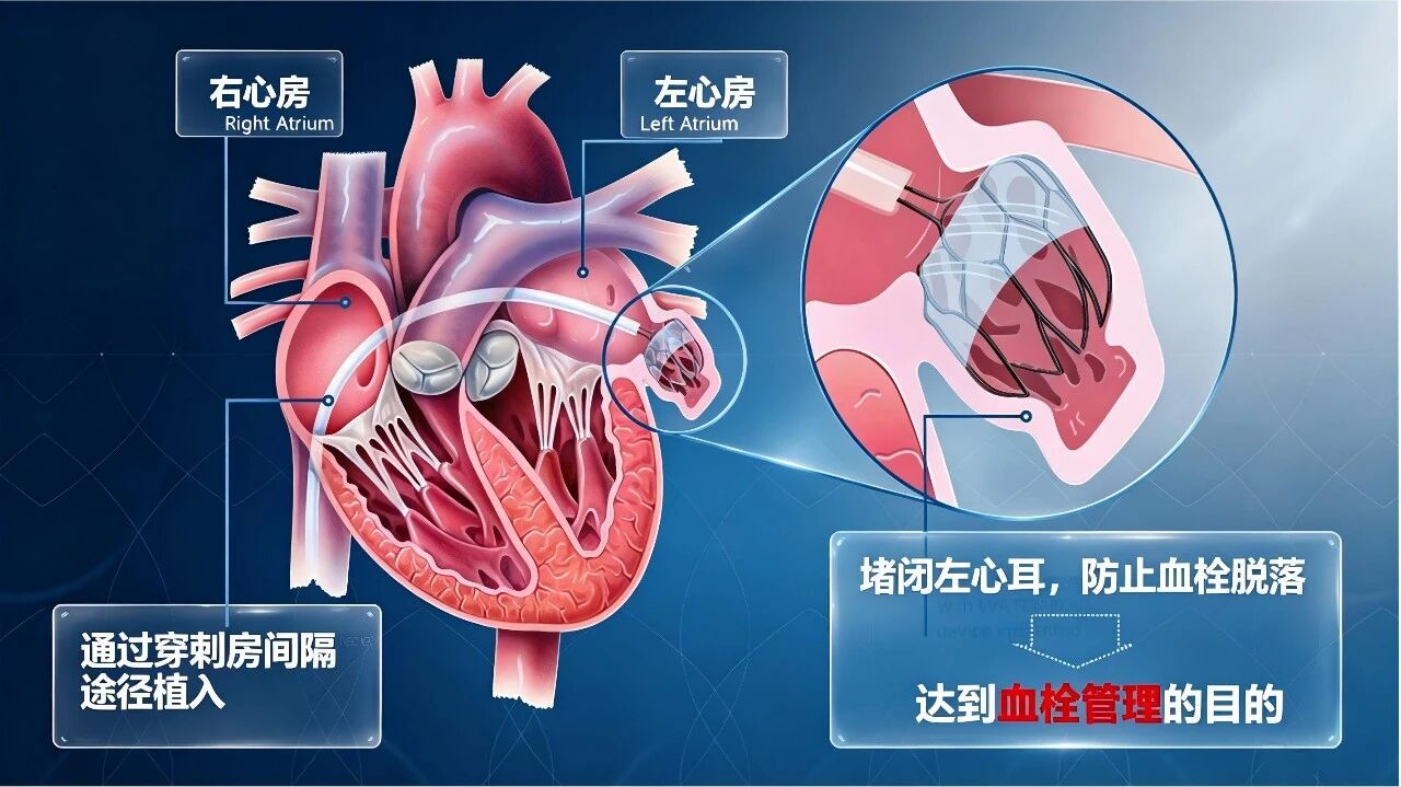 左心耳封堵术操作简图