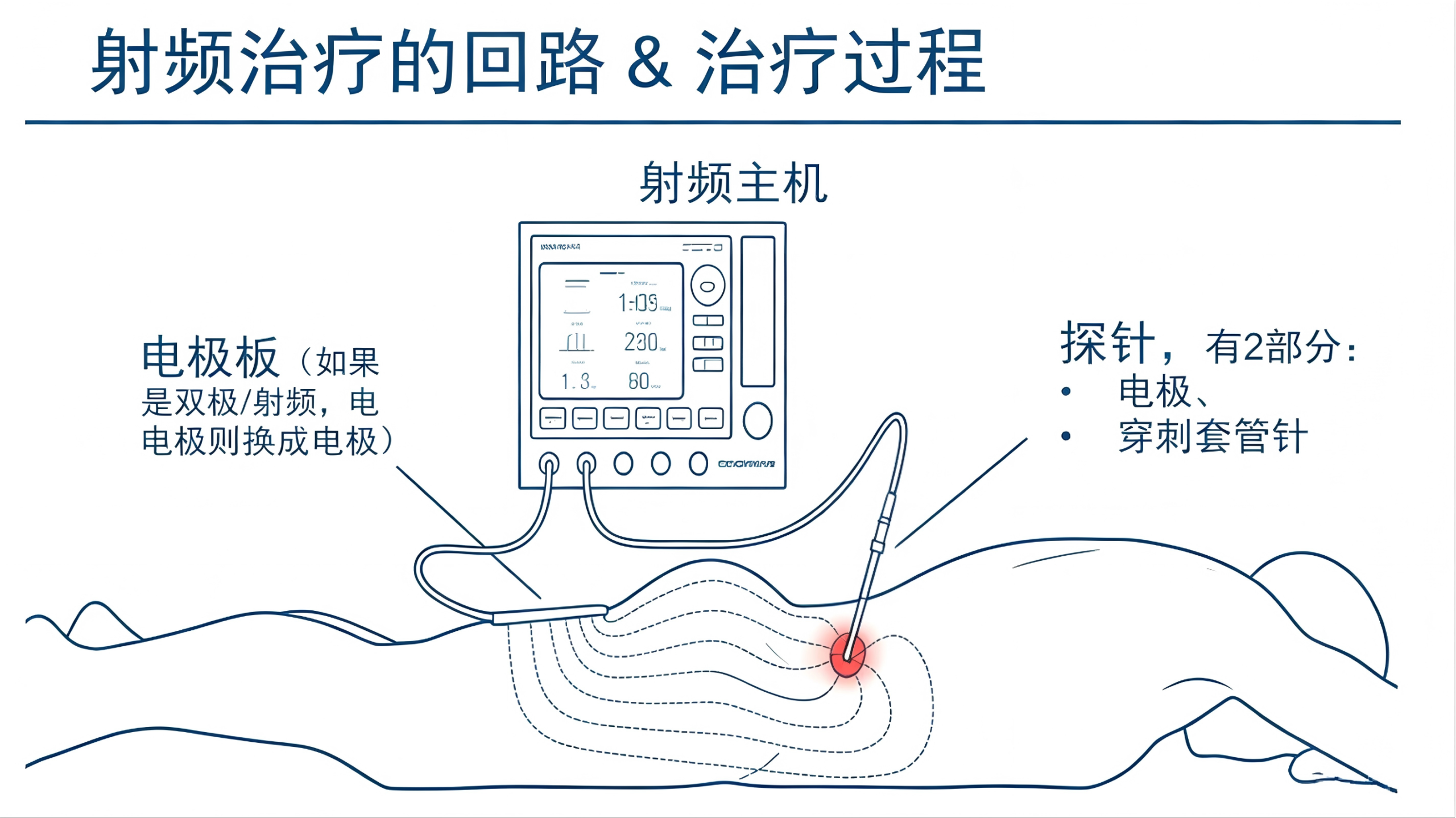射频消融术