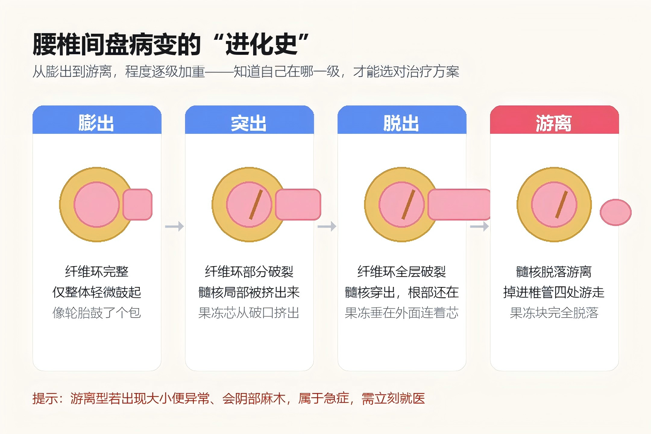 腰间盘突出