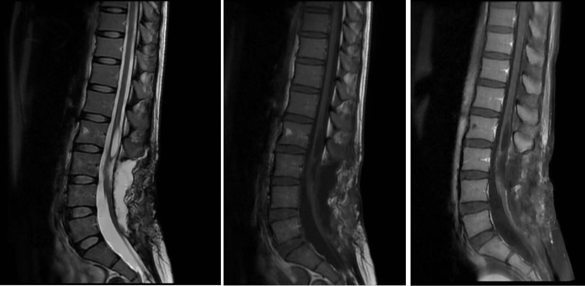 术后腰椎MRI